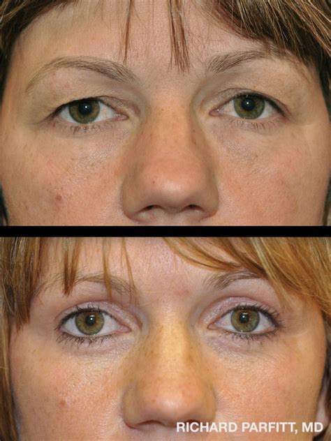 Best eyelid surgery brooklyn  In the lower lid, a cut is made either inside the lower lid or the eye's natural crease