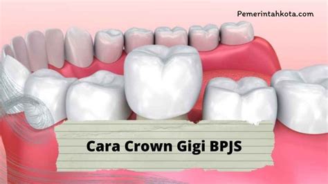 Biaya crown gigi ditanggung bpjs Biaya kesehatan gigi dapat memakan biaya dari Rp150 ribu sampai Rp300 ribu