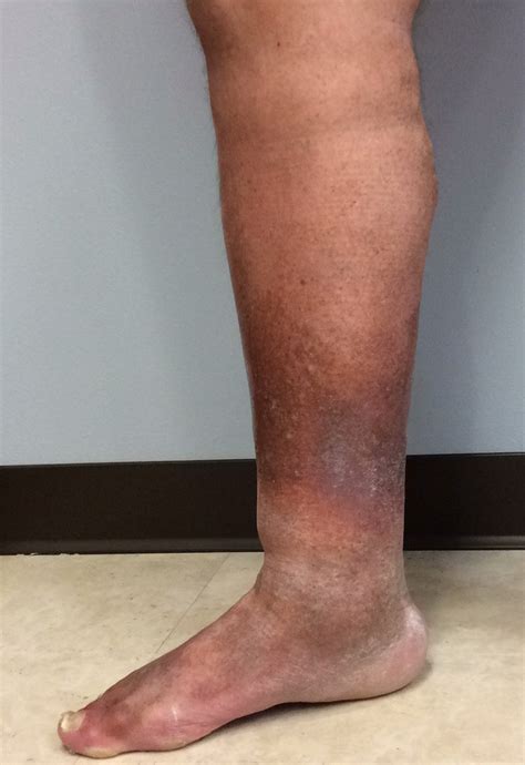 Bilateral lower extremity venous insufficiency icd 10  I am only finding I87