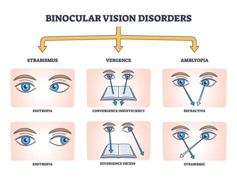 Binox vision therapy  ATN BinoX-4K 4-16x65 Night Vision Binocular with Laser Rangefinder