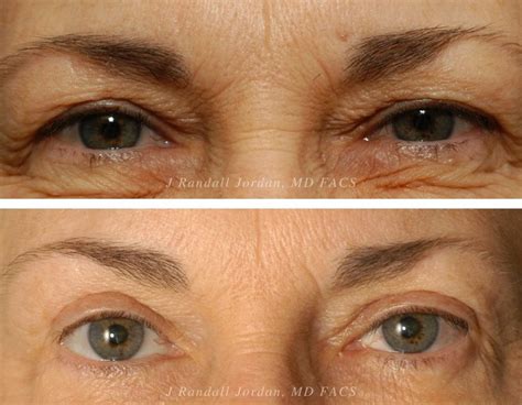 Blepharoplasty mcminnville Blepharoplasty refers to the aesthetic or functional surgical manipulation of the upper or lower eyelids