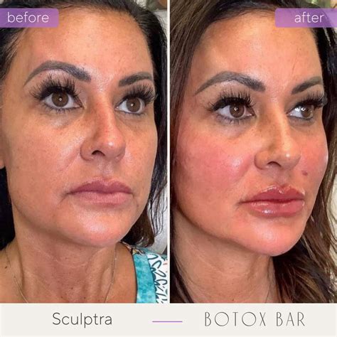 Botox bar in plano texas  Our services include acne, psoriasis, eczema, skin cancer,