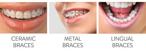 Braces cost mooroolbark  Tablets are the easiest product for many people