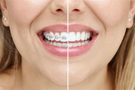 Braces cost mooroolbark  You’ll need to check the details of your specific plan or invest in a new one