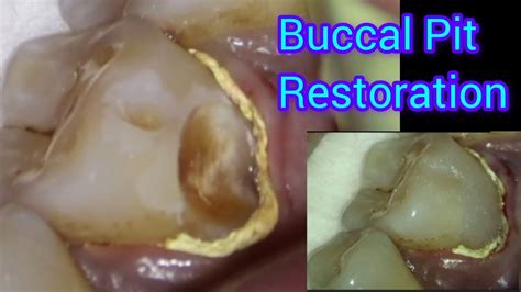 Buccal pit cavity These planes should approximate the cusps of a molar 1 mm to 2 mm toward the center of the occlusal center or the width of the incisal edge of the anterior teeth