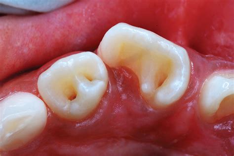 Buccal pit treatment  Mesial – this is a side surface of the tooth; the side that is closer to the front of the mouth