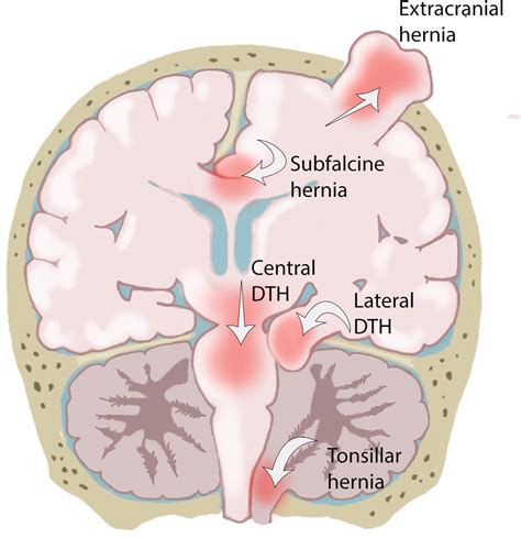 Build a medical term that means brain hernia.  e