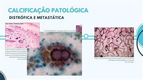 Calcificações patológicas  6 pigmentacoes e calcificacoes v2 (1) - Transferir como PDF ou ver online gratuitamente