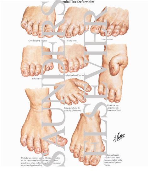 Cavus foot deformity icd 10 The 2024 edition of ICD-10-CM S13