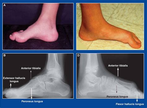 Cavus foot deformity icd 10  The deformities are still not fully understood, and the treatment recommendations are consequently heterogeneous, often including calf muscle or Achilles tendon lengthening
