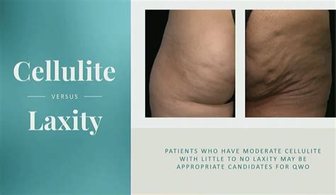 Cellulite reduction san ramon  Best Deal of the Year! Fixed monthly payments are required until paid in full and will be calculated as follows: on 24-month promotions – 4