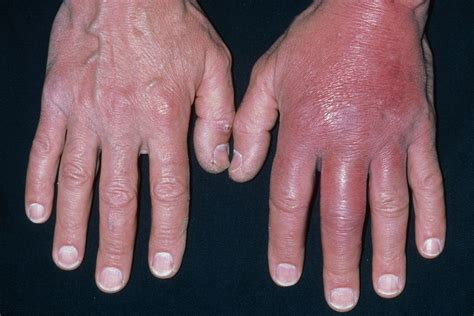 Cellulitis of finger of left hand icd 10 512: 681