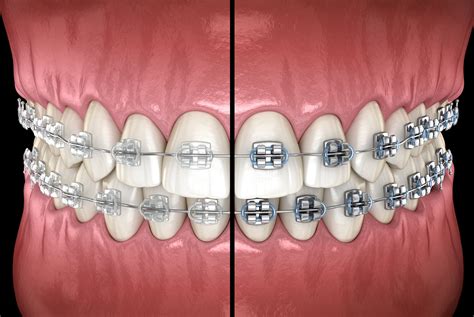 Ceramic braces saline  This threshold differs from state to state