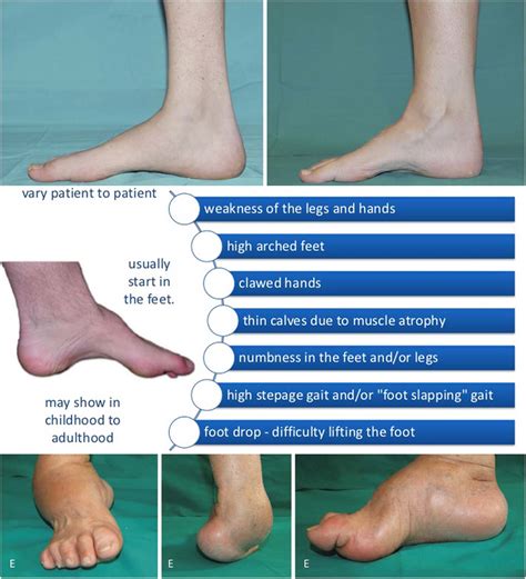 Charcot marie tooth disease icd10  Dejerine Sottas disease (hypertrophic interstitial neuropathy) is a rare hereditary sensory and motor neuropathy