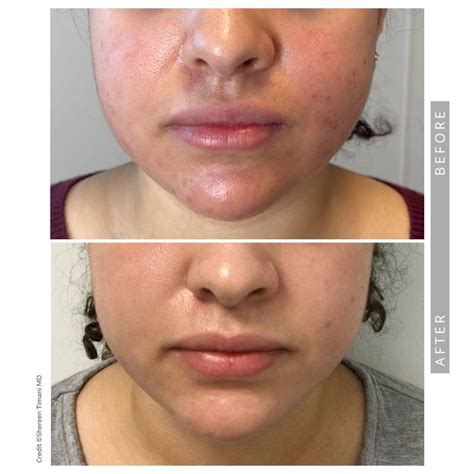 Chemical peels in johnscreek  The skin may peel without blistering