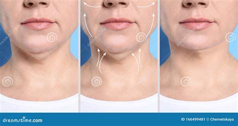 Chin surgery okanagan  Surgery to correct bite problems (orthognathic surgery) can be done at the same time as chin surgery