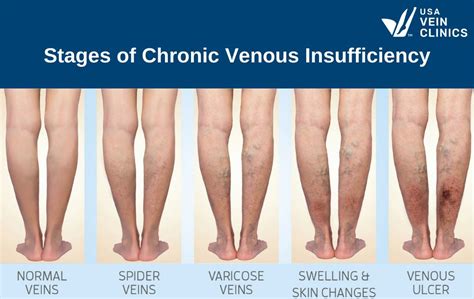 Chronic venous insufficiency icd 10  Chronic deep venous thrombosis of left lower extremity; ICD-10-CM I82