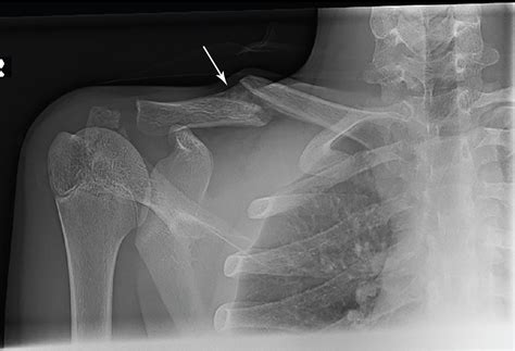 Clavicle trauma southlake <cite> Common causes of a broken collarbone include: Falls, such as falling onto the shoulder or onto an outstretched arm</cite>