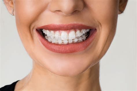 Clear braces merrylands  Some adults want to correct problems with their teeth or jaws before they cause serious or further damage