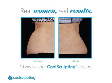Coolsculpting moncton  It was the most used body sculpting