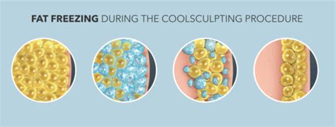 Coolsculpting rockwall CoolSculpting University CoolSculpting Master CoolSculpting Master’s Business Administration Be the best at what you do! We believe in training!