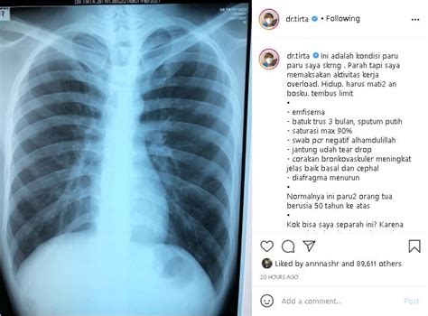 Corakan bronkovaskuler bertambah artinya  corakan bronkovaskuler nampak hingga ke perifer C : mediastinum terletak di tengah, ukuran jantung melebar >60%,