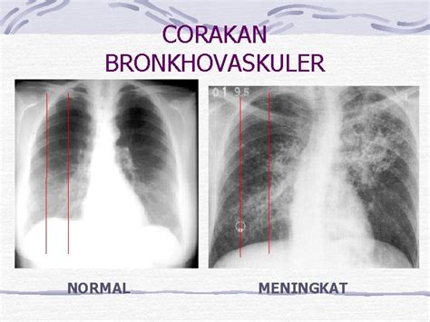 Corakan bronkovaskuler kasar artinya  FULL MASTER EMG IPD TORAKS PA DAN LATERAL NORMAL Â· Foto simetris dan inspirasi maksimal…corakan bronkovaskuler kasar, tampak streaky line minimal
