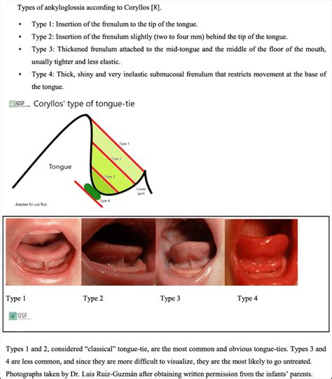 Coryllos ankyloglossia grading scale  (See Table 1