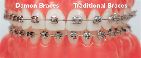 Damon braces cost vs traditional 1