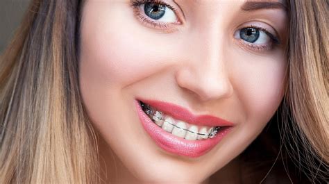 Damon braces cost vs traditional  This high cost is one of the things that prevents many people from seeking treatment