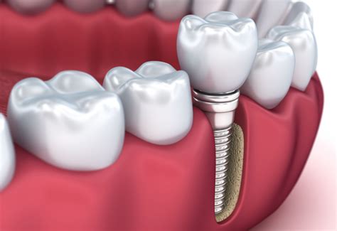 Dental implants bendmeer  Rick Kline