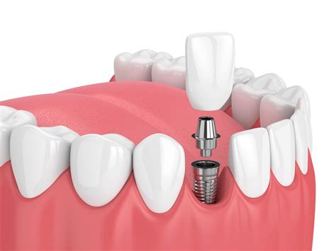 Dental implants fort pierce  About Us