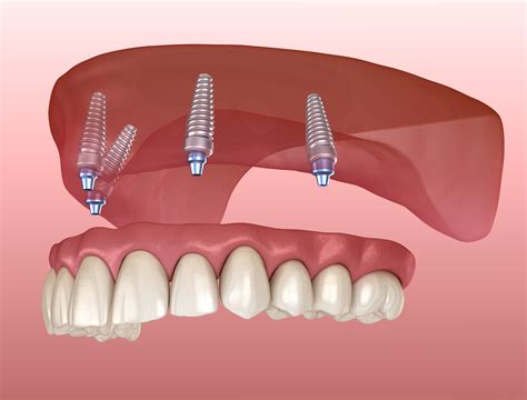 Dental implants laguna hills  Sinus Lift Augmentation:Often the sinuses will enlarge following loss of the upper back teeth