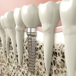Dental implants laguna niguel ca  39 Creek Rd Suite #210, Irvine, CA 92604 (949) 857-6757 [email protected] Laguna Niguel, CA