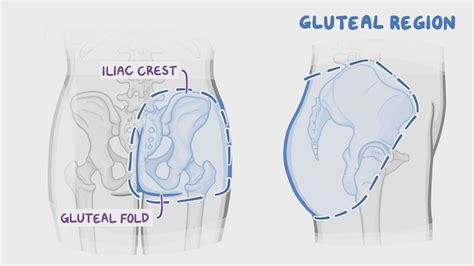 Deviated gluteal cleft  A