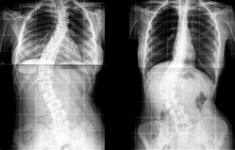 Dextroconvex curvature of the lumbar spine Dextroscoliosis is an abnormal curvature of the spine that bends to the right and away from the heart