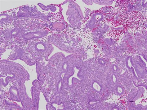 Disordered proliferative phase endometrium  In the proliferative phase, the endometrium gradually thickens with an increase in E