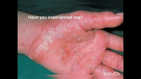 Dyshidrotic eczema popping  The lesions can be irritating, painful, and itchy and usually persist for two or three weeks
