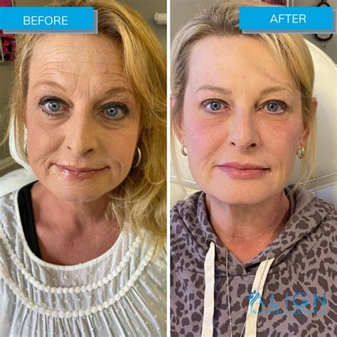 Dysport moncton  It’s FDA-approved to treat moderate to severe frown lines, also called glabellar lines or “11s,” between the eyebrows