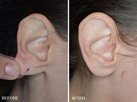 Earlobe repair edina Learn More About Earlobe Repair in Tampa