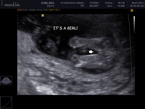 Early gender ultrasound  Also, a 2D, 3D peek Ultrasound that determines gender starting at 14