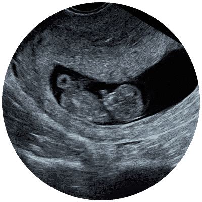Early pregnancy scan 6 weeks near me  (6 - 9 weeks) Dating Scan (9 - 16 weeks) NIPT Scan (Down's syndrome testing) quick ASSURE TM Scan (12 - 24 weeks) Gender Scan (16 -