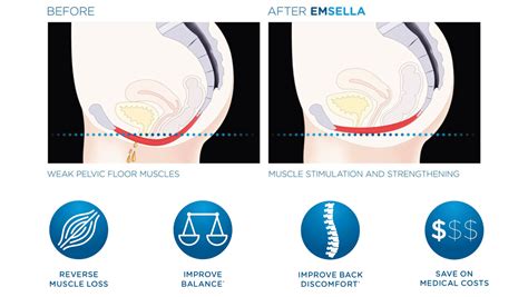 Emsella issaquah During a BTL Emsella session at Bioscor Perth, you will remain fully clothed while comfortably seated on the specialized Emsella chair