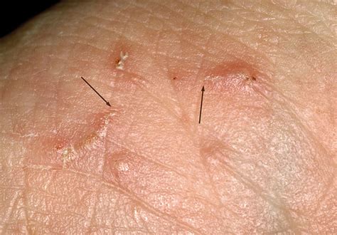 Escorts scabies forum  Scabies is a skin condition caused by a tiny mite that gets under the skin and lays eggs