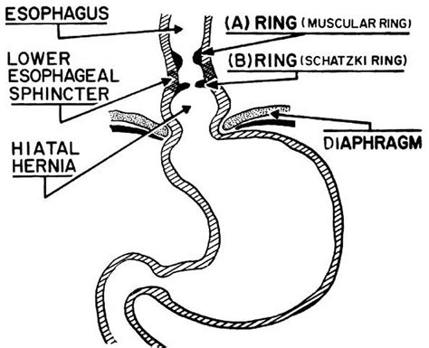 Esophageal ring schatzki's ring  This article is part of an expert video