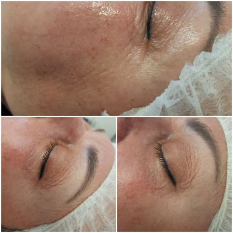 Eyecon treatment dublin DERMALUX IS THE BEST! •Recognised as a world leading, premium British brand for LED Phototherapy •Dermalux is a multi-award winning treatment:Five times winner of Best Treatment at the UK Aesthetic Awards and Best UK Manufacturer 2019Eyecon Design Consultants in Dublin, reviews by real people