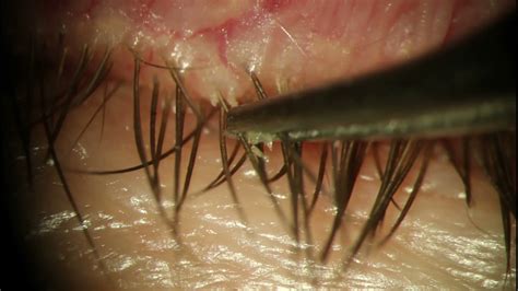 Eyelash folliculitis  Gran+ coagulase is neg 90% of normal skin microbiota