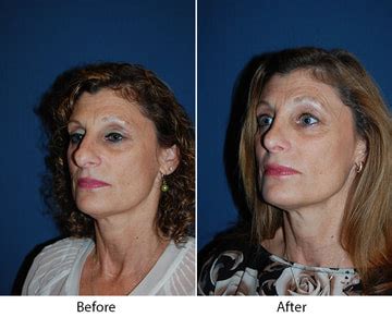 Facial feminization surgery charlotte nc  200 Hawthorne Ln Charlotte, NC 28204