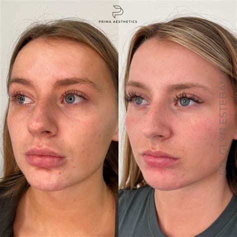 474px x 474px - Facial rejeuvenation consultation