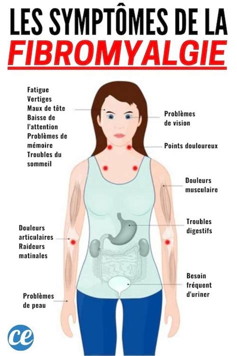 Fibromyalgie symptômes  Les principaux symptômes de la fibromyalgie: douleur (100%), raideur (77%) et fatigue (81,4%)
